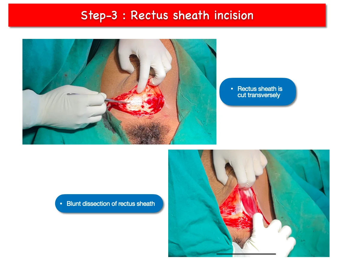 LSCS step-3